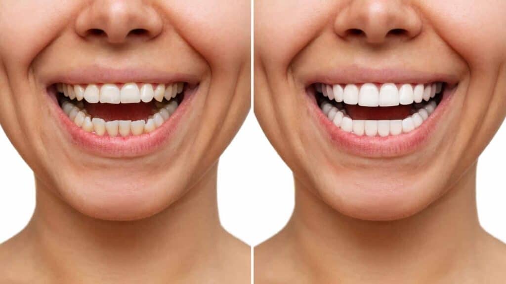 Before and after teeth whitening results. Sutton