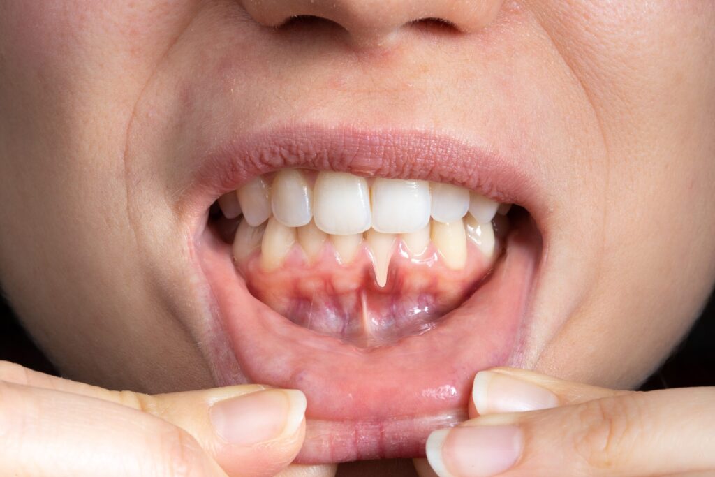 Preparing for teeth whitening with receding gums Sutton